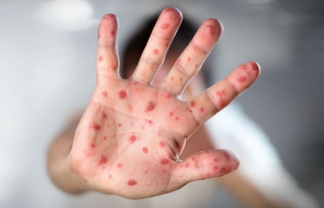 epidemie-de-rougeole-comment-reconnaitre-les-symptomes-de-cette-maladie-tres-contagieuse
