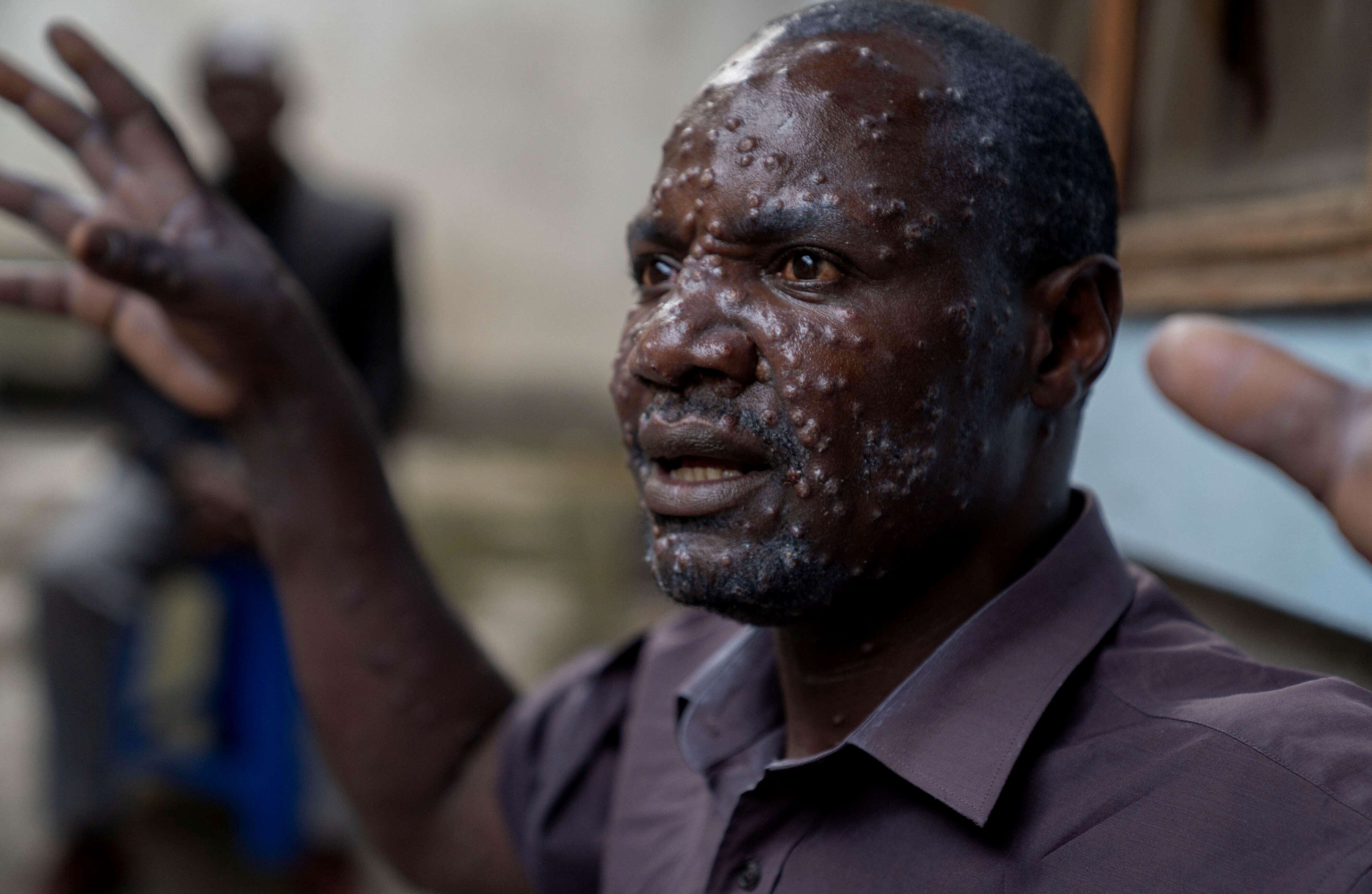 Children at risk as mpox variant hits Congo displacement camps